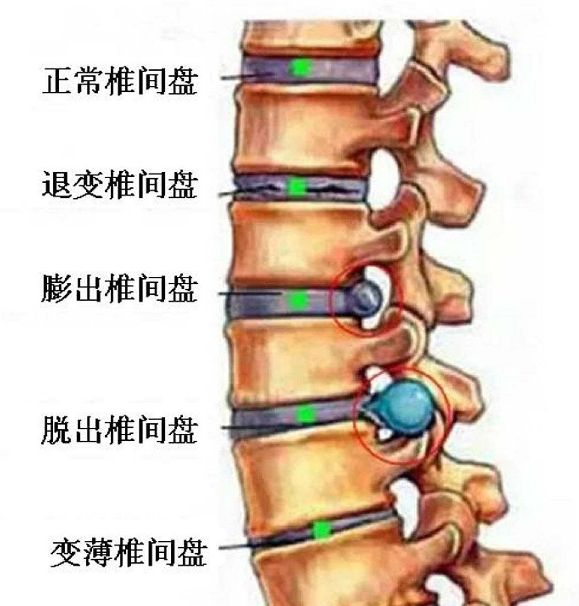 腰椎间盘突出症.jpg