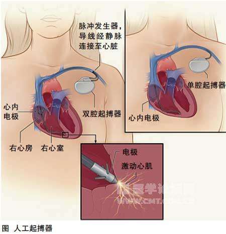 人工心脏起搏器2.jpg