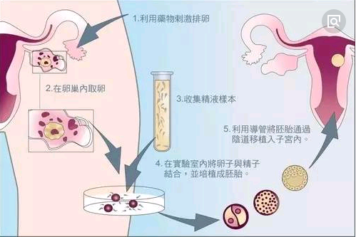 体外受精-胚胎移植(ivf-et)示意图