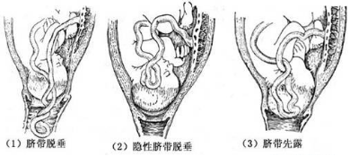 脐带先露.png