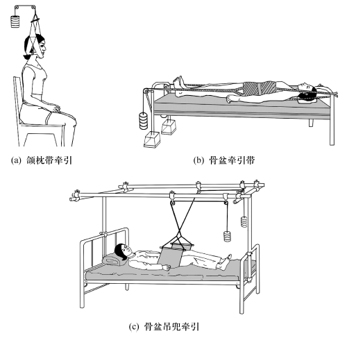 兜带牵引(3)手术复位内固定:即通过手术切开的方法,在直视下对骨折