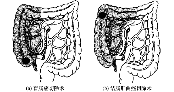 常用术式有①右半结肠切除术:适用于盲肠,升结肠,结肠肝曲的癌肿.