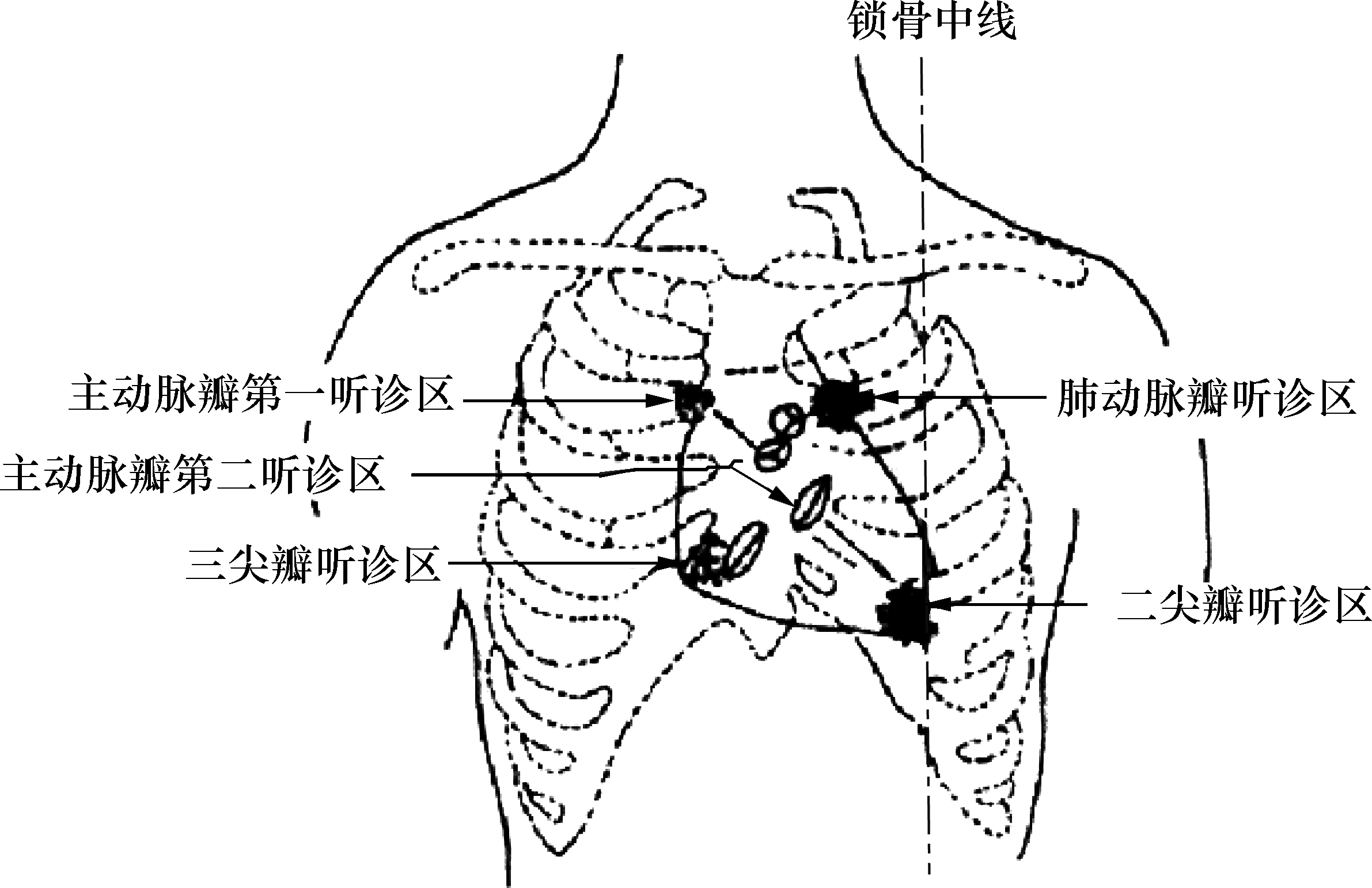 (3)确定听诊部位(图4-14):  二尖瓣听诊区:左第五肋间锁骨中线稍