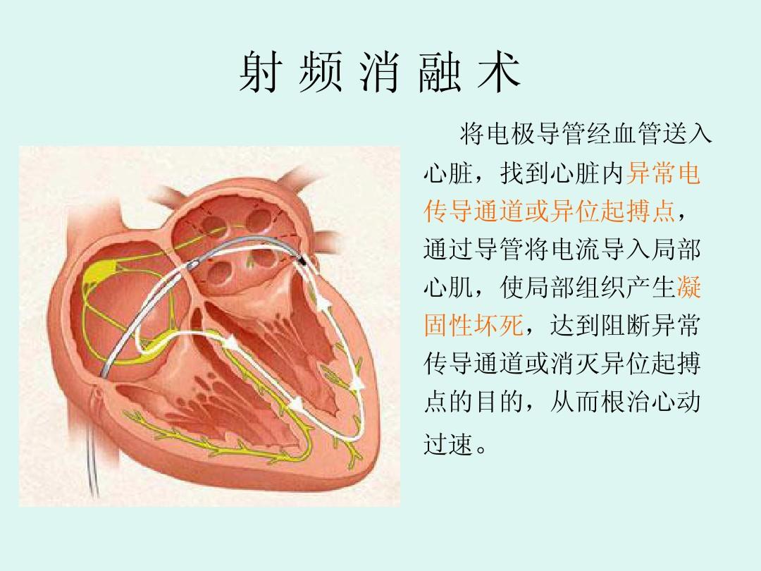 心导管射频消融术﹙rfca﹚是通过插入心脏内心导管头端的电极释放射频