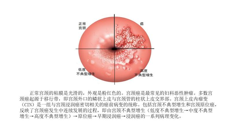 正常宫颈与宫颈癌.png