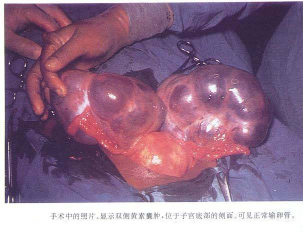 卵巢黄素囊肿.png
