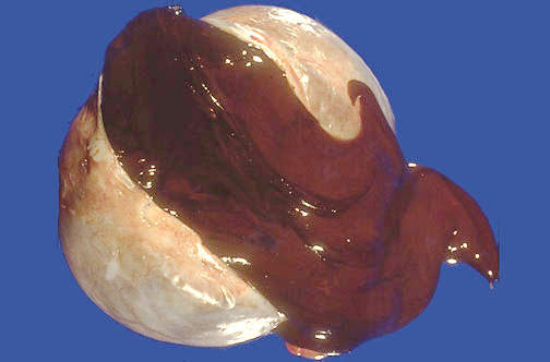 卵巢巧克力囊肿严重图片