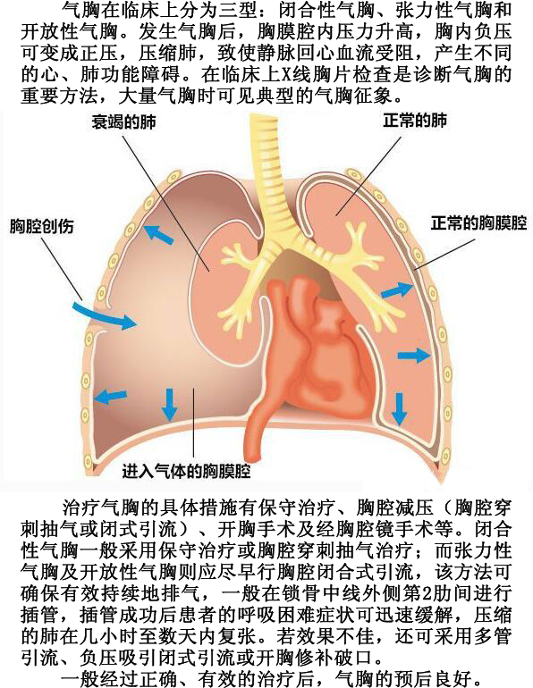胸膜腔压力图片