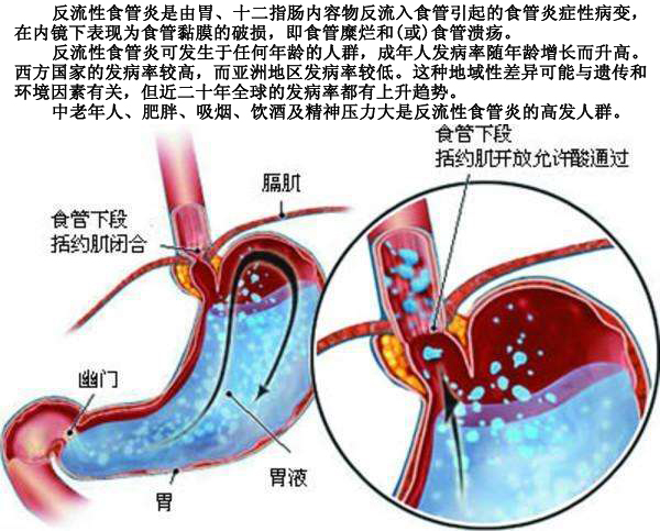 0604反流性食管炎.jpg