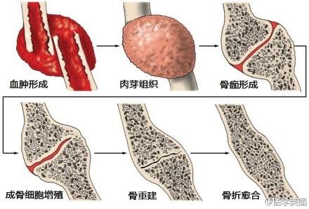 骨折愈合过程图片