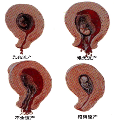 流产的临床类型及表现