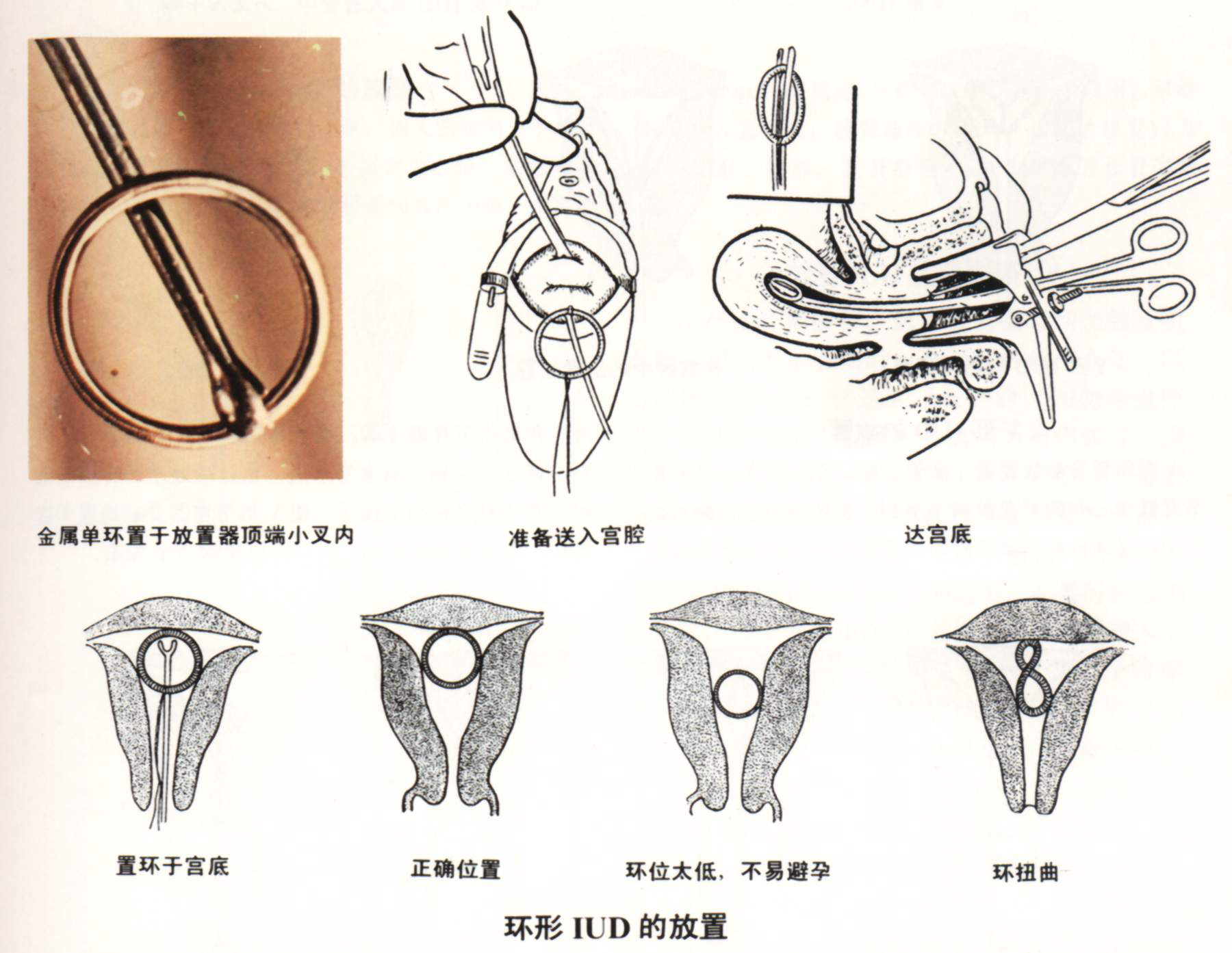 ③沿宫腔方向将叉偏水平位通过宫颈管后转正,将环送达宫底;④然后将