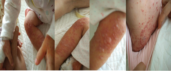 入院第三天Cox A6手足口病患者皮疹1.png