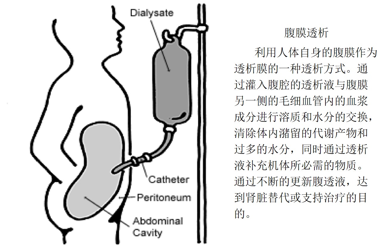腹膜透析置管术图解图片