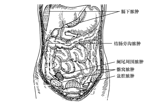 (2)炎症扩散:若腹膜炎较重,人体抵抗力较弱,治疗不及时,腹膜炎可加重