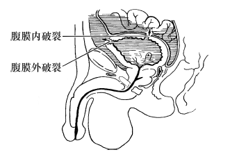 膀胱破裂图片