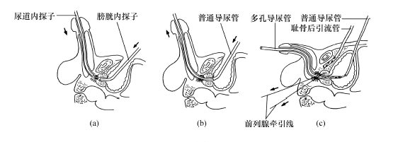 尿道會師復位術