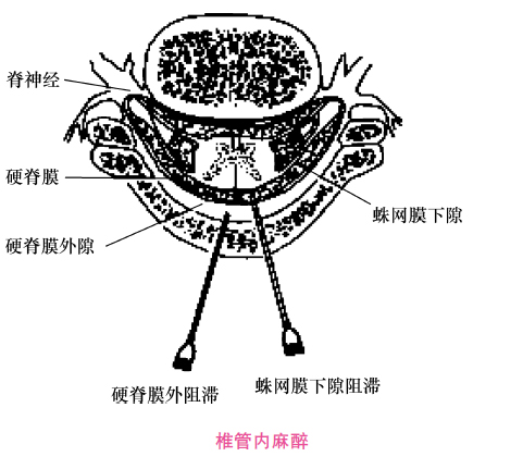 椎管内麻醉平面图片