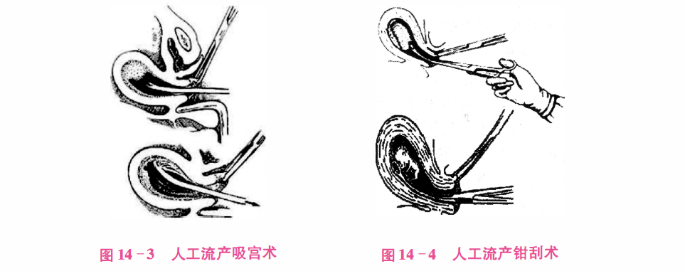 胎儿钳夹术过程图图片